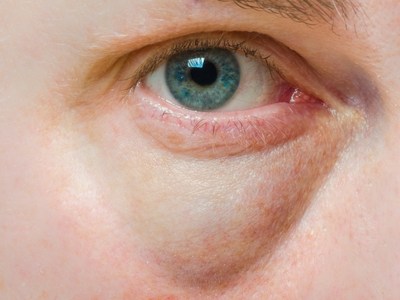 روش‌های درمان پف زیر چشم